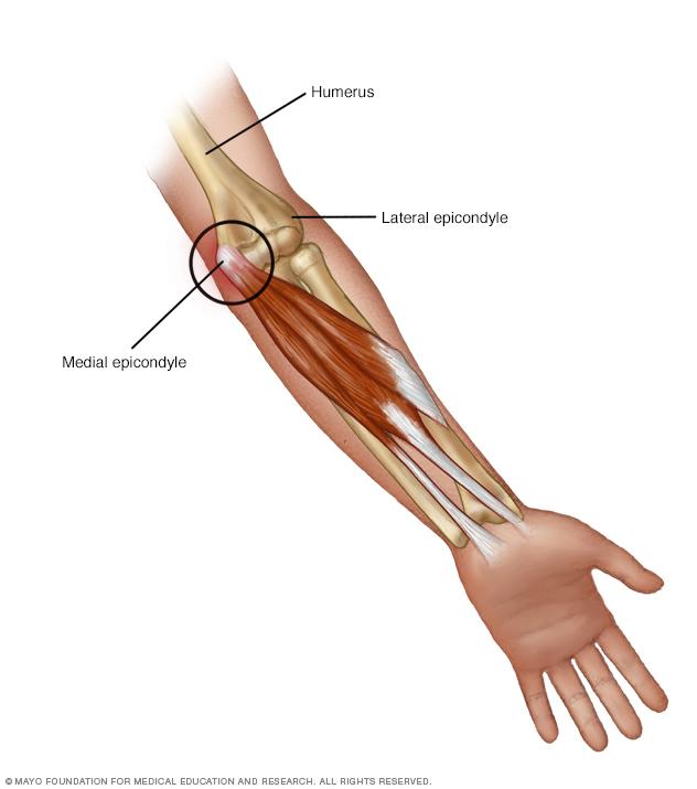 Bone Golfe: What Is It and How to Prevent It?